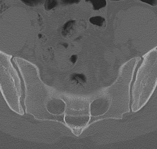 File:Normal lumbar spine CT (Radiopaedia 46533-50986 Axial bone window 77).png
