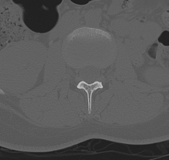File:Normal lumbosacral CT (Radiopaedia 37923-39867 Axial bone window 45).png