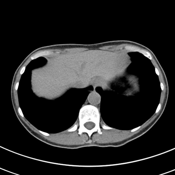 File:Normal multiphase CT liver (Radiopaedia 38026-39996 Axial non-contrast 7).jpg