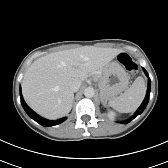 File:Normal multiphase CT liver (Radiopaedia 38026-39996 C 15).jpg