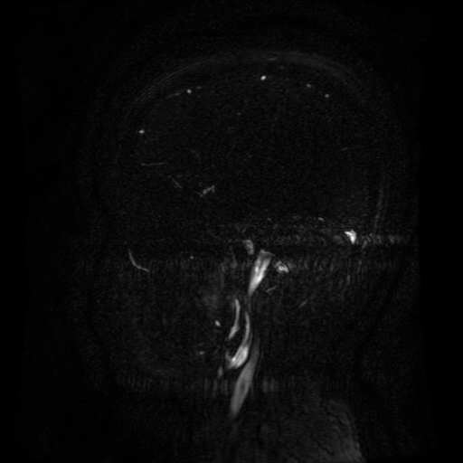 Normal noncontrast MR venography (Radiopaedia 87578-103957 A 45).jpg