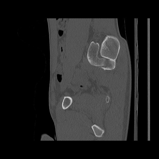 Normal pelvis (Radiopaedia 51473-57238 Sagittal bone window 52).jpg