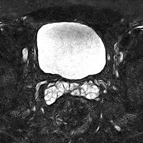 File:Normal prostate (MRI) (Radiopaedia 29986-30535 Axial STIR 19).jpg
