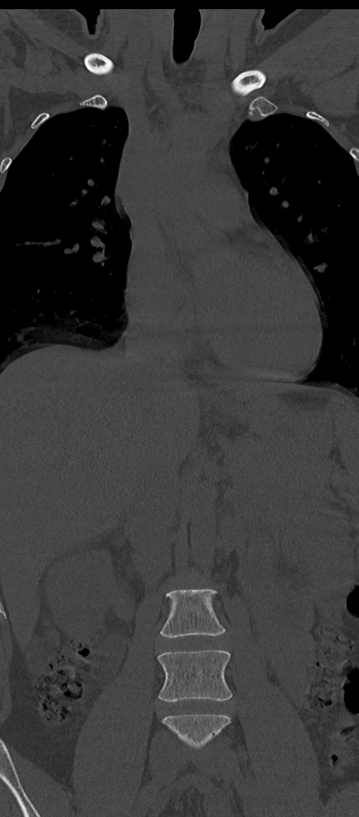 Normal thoracolumbar spine (Radiopaedia 43822-47309 Coronal bone window 24).png