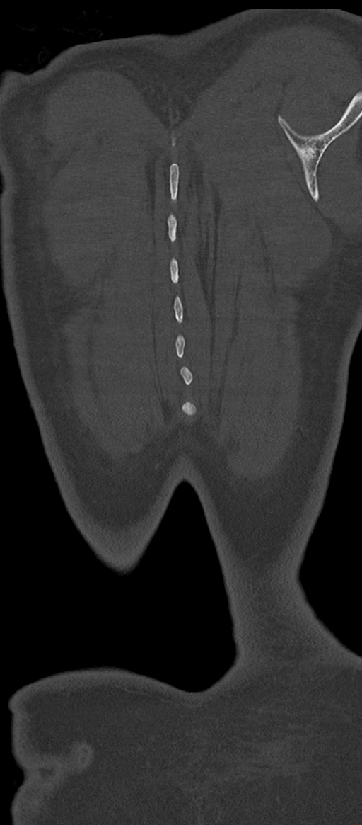 Normal thoracolumbar spine (Radiopaedia 43822-47309 Coronal bone window 90).png
