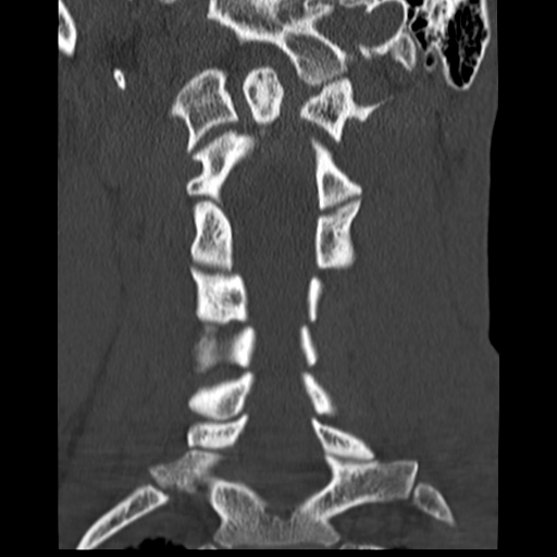 File:Normal trauma cervical spine (Radiopaedia 41017-43760 Coronal bone window 21).png