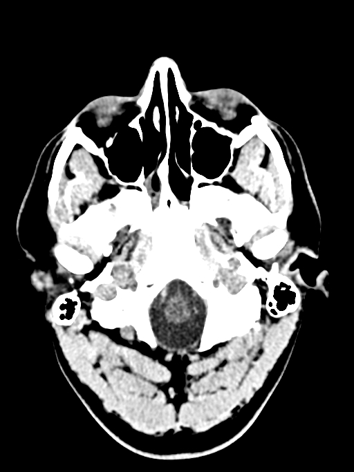 Normal trauma protocol brain and C-spine CT (Radiopaedia 83302-97709 Axial non-contrast 63).jpg