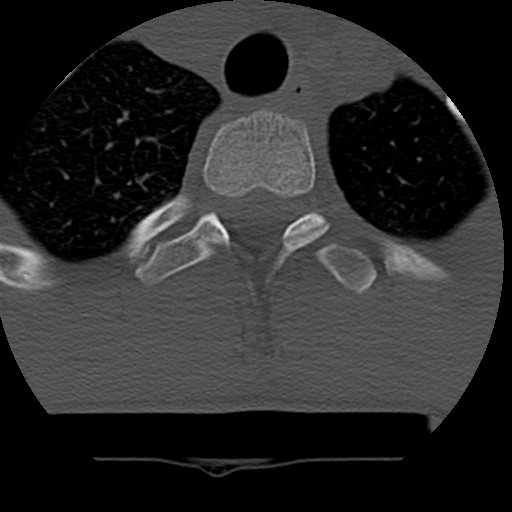 File:Normal trauma spine imaging (age 16) (Radiopaedia 45335-49358 Axial bone window 84).jpg