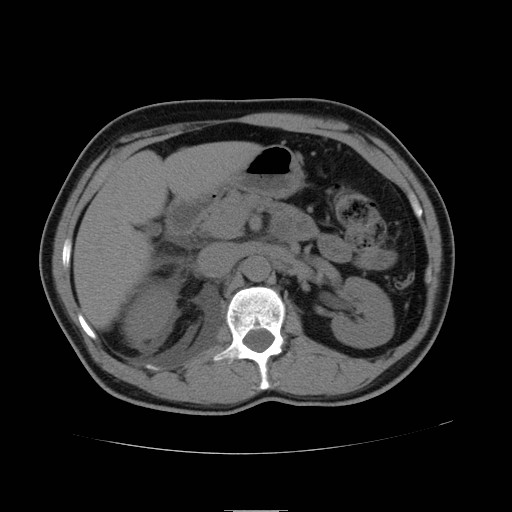 File:Obstructed kidney with perinephric urinoma (Radiopaedia 26889-27066 Axial non-contrast 15).jpg