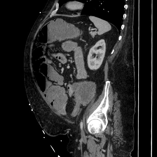 Obstructive colonic diverticular stricture (Radiopaedia 81085-94675 C 164).jpg