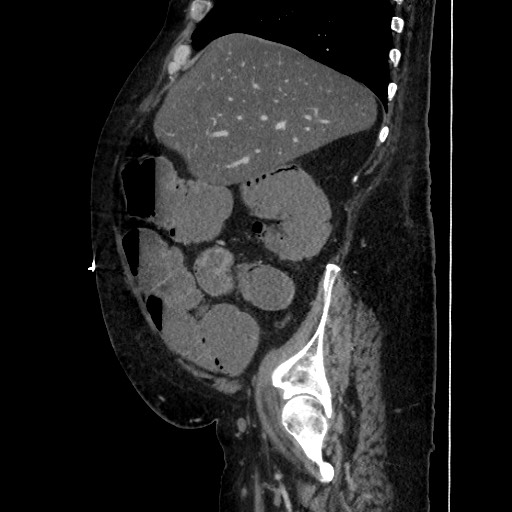 Obstructive colonic diverticular stricture (Radiopaedia 81085-94675 C 73).jpg