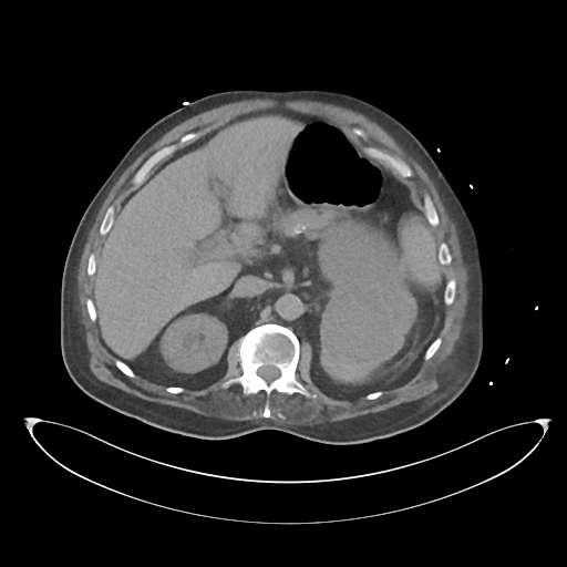File:Obstructive pyelonephritis (Radiopaedia 46411-50844 Axial non-contrast 27).png