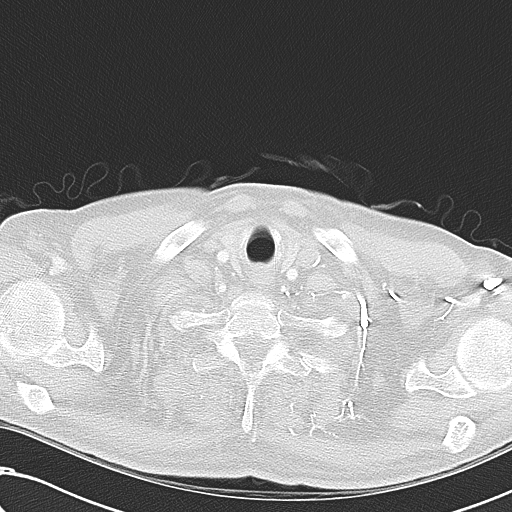 File:Obstructive superior vena cava tumor thrombus (Radiopaedia 28046-28306 Axial lung window 2).jpg