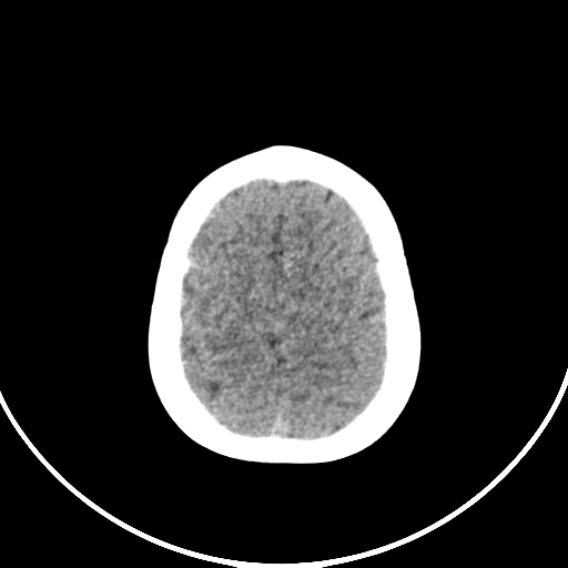 Occipital encephalocele (Radiopaedia 87339-103636 Axial non-contrast 70).jpg
