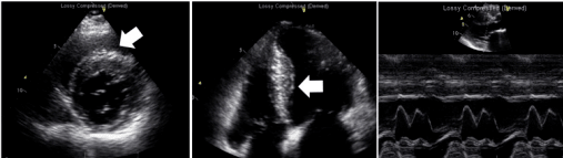 Echocardiogram exam shows left atrial enlargement (asymmetrical septal hypertrophy without left ventricle (LV) outflow tract obstruction, restrictive filling pattern, normal LV systolic function)[6]