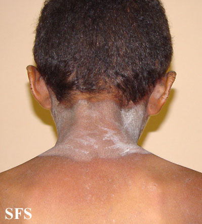 File:Pellagra (Dermatology Atlas 25).jpg