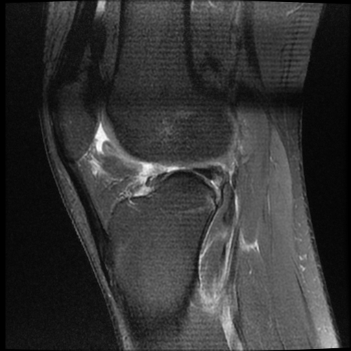 File:ACL acute full thickness tear - deep lateral femoral sulcus sign (Radiopaedia 38594-40740 Sagittal PD fat sat 14).jpg