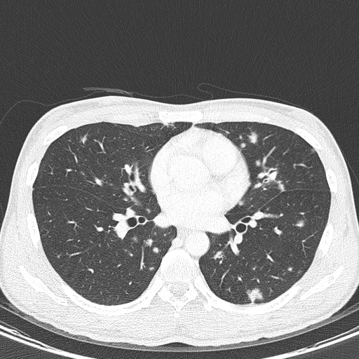 File:AIDS-related Kaposi sarcoma (Radiopaedia 85247-100811 Axial lung window 93).jpg