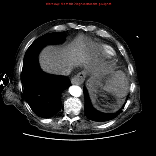 Abdominal aortic aneurysm- extremely large, ruptured (Radiopaedia 19882-19921 Axial C+ arterial phase 7).jpg
