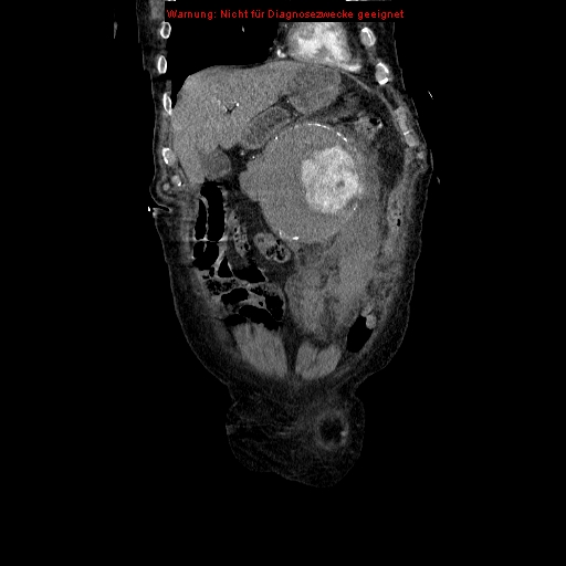 Abdominal aortic aneurysm- extremely large, ruptured (Radiopaedia 19882-19921 Coronal C+ arterial phase 24).jpg