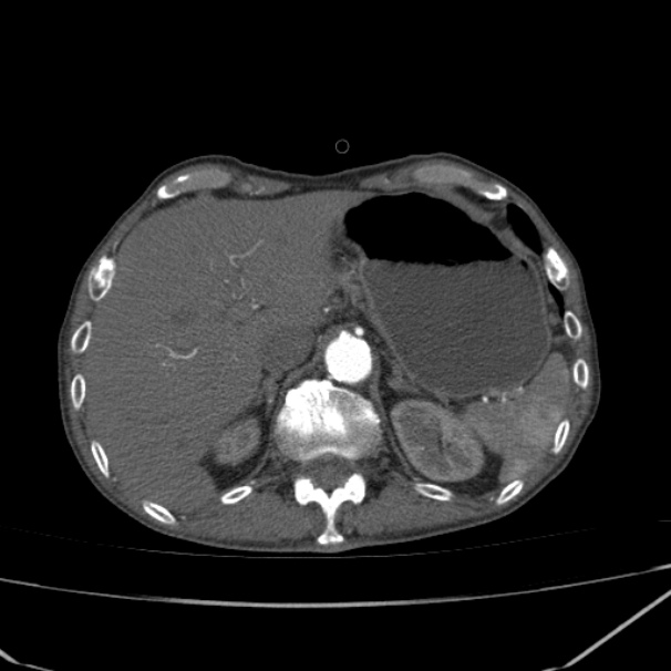 Abdominal aortic aneurysm (Radiopaedia 23703-23856 Axial C+ arterial phase 12).jpg
