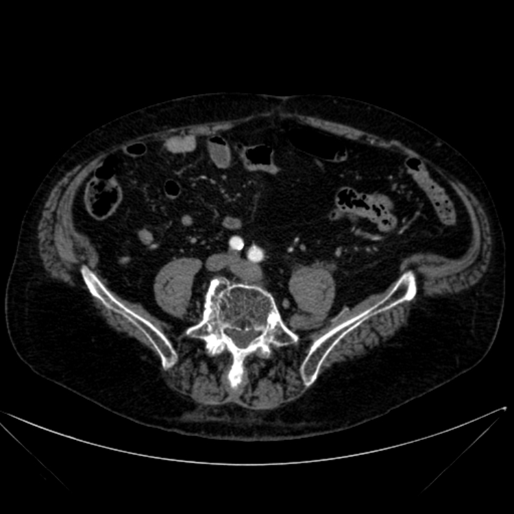 Abdominal aortic aneurysm (Radiopaedia 25855-26001 Axial C+ arterial phase 91).jpg