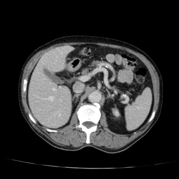 Abdominal aortic aneurysm (Radiopaedia 29248-29660 Axial C+ portal venous phase 20).jpg