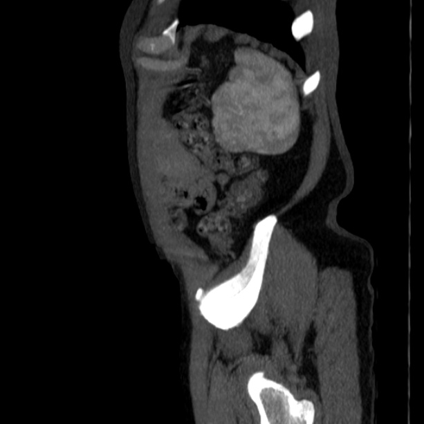 Abdominal aortic aneurysm (Radiopaedia 29248-29660 Sagittal C+ arterial phase 51).jpg