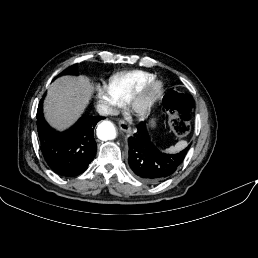 Abdominal aortic aneurysm (Radiopaedia 67117-76452 Axial C+ arterial phase 14).jpg