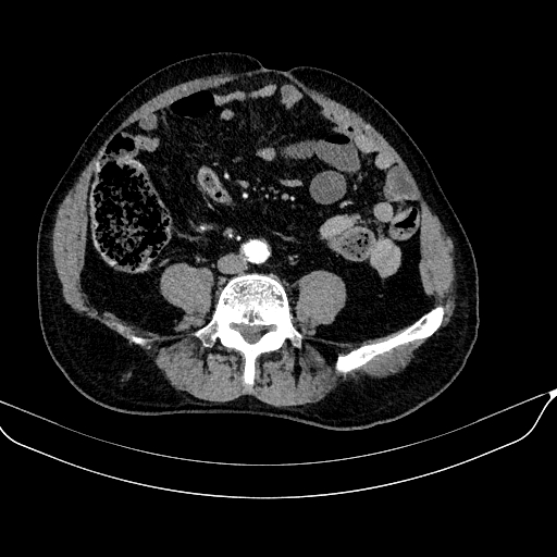 Abdominal aortic aneurysm (Radiopaedia 67117-76452 Axial C+ arterial phase 88).jpg
