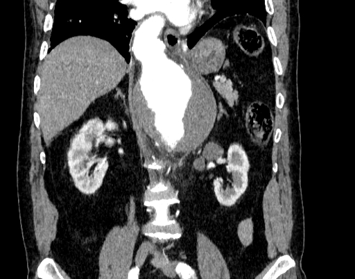 Abdominal aortic aneurysm (Radiopaedia 67117-76452 Coronal C+ arterial phase 57).jpg