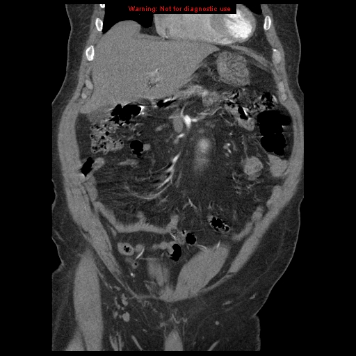 File:Abdominal aortic aneurysm (Radiopaedia 8190-9038 Coronal C+ arterial phase 35).jpg