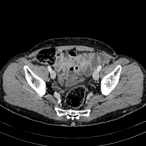 Abdominal aortic aneurysm (Radiopaedia 83581-98689 Axial C+ portal venous phase 95).jpg