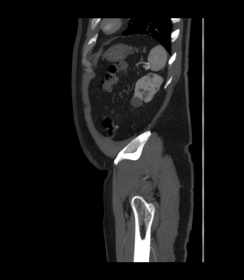 Abdominal aortic aneurysm with thrombus fissuration (Radiopaedia 46218-50618 Sagittal C+ arterial phase 51).jpg