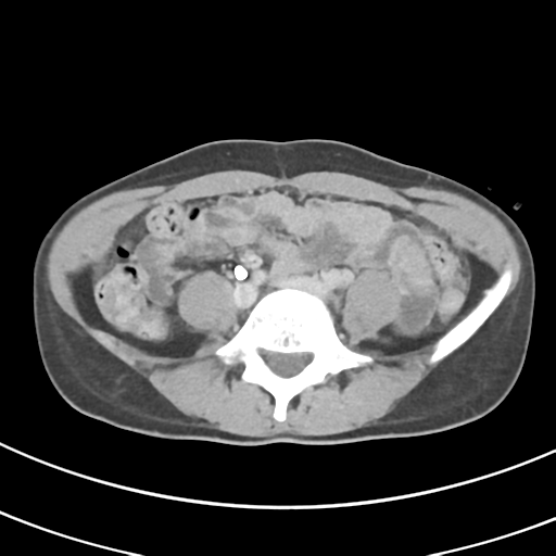 File:Abdominal multi-trauma - devascularised kidney and liver, spleen and pancreatic lacerations (Radiopaedia 34984-36486 Axial C+ delayed 52).png