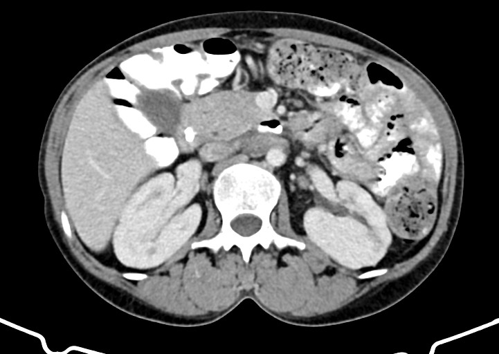 Abdominal wall and retroperitoneal tuberculosis (Radiopaedia 88137-104729 Axial C+ portal venous phase 75).jpg