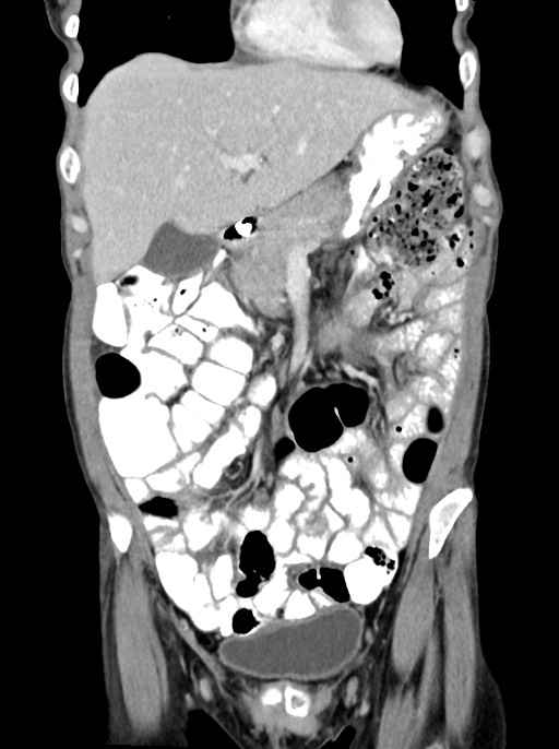 Abdominal wall and retroperitoneal tuberculosis (Radiopaedia 88137-104729 Coronal C+ portal venous phase 30).jpg