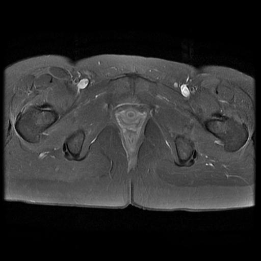 File:Abdominal wall endometriosis (Radiopaedia 83702-98847 H 17).jpg