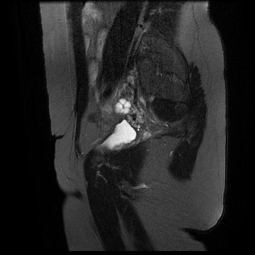 File:Abdominal wall endometriosis (Radiopaedia 83702-98847 Sagittal T2 fat sat 4).jpg
