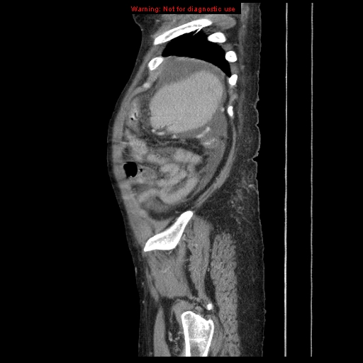 File:Abdominal wall hematoma (Radiopaedia 9427-10112 Sagittal C+ portal venous phase 17).jpg