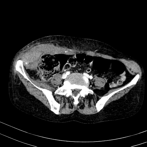 Abdominal wall hematoma with active bleeding (Radiopaedia 83915-99117 Axial renal cortical phase 84).jpg