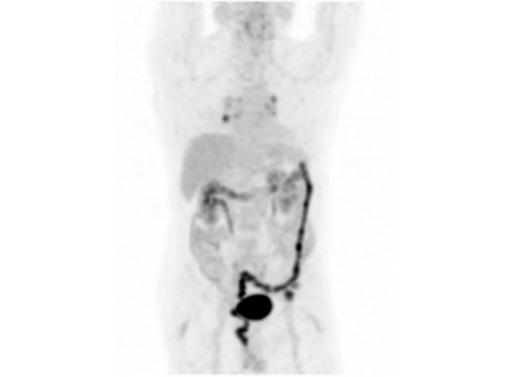 File:Abdominal wall metastasis from colorectal carcinoma (Radiopaedia 31016-31719 Rotational MIP 30).jpg