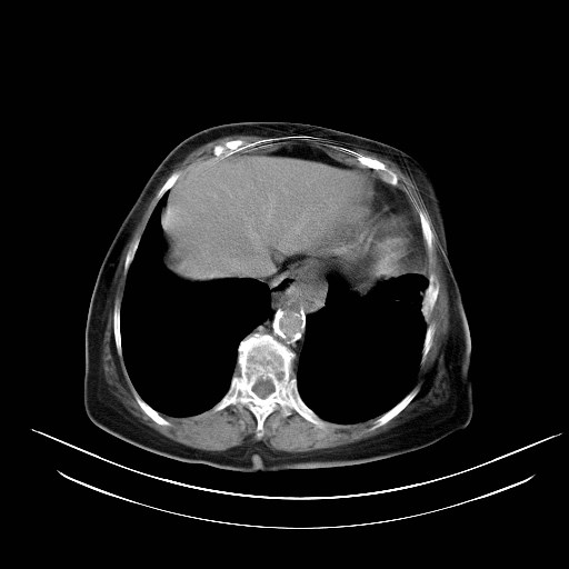 File:Abdominal wall recurrence after colorectal resection for cancer (Radiopaedia 23444-23523 Axial C+ portal venous phase 1).jpg