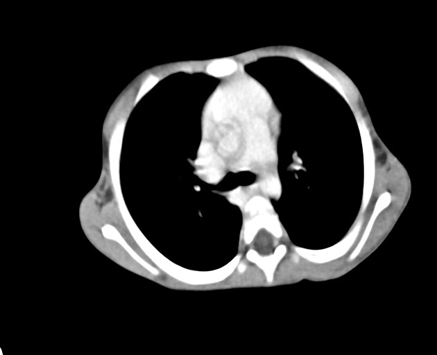 File:Abdominopelvic rhabdomyosarcoma (Radiopaedia 78356-90984 Axial C+ portal venous phase 16).jpg