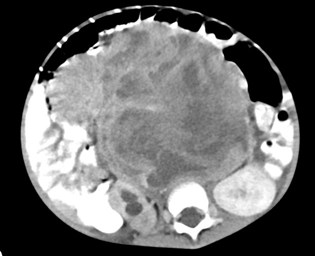 Abdominopelvic rhabdomyosarcoma (Radiopaedia 78356-90984 Axial C+ portal venous phase 93).jpg