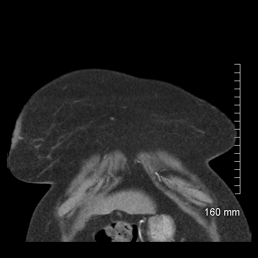 File:Aberrant right subclavian artery stenosis (Radiopaedia 52656-58670 B 13).jpg