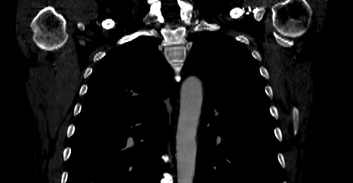 File:Accesory rib joint (Radiopaedia 71987-82452 Coronal bone window 13).jpg
