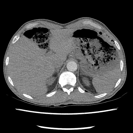 Accessory left horizontal fissure with lingular pneumonia (Radiopaedia 53763-59843 Axial C+ CTPA 86).jpg