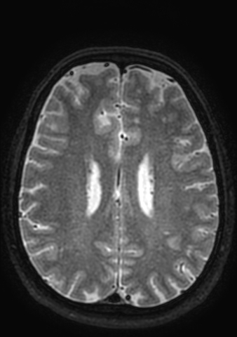 Accessory middle cerebral artery (Radiopaedia 73114-83828 Axial T2 15).jpg