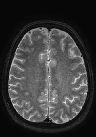 Accessory middle cerebral artery (Radiopaedia 73114-83828 Axial T2 2).jpg
